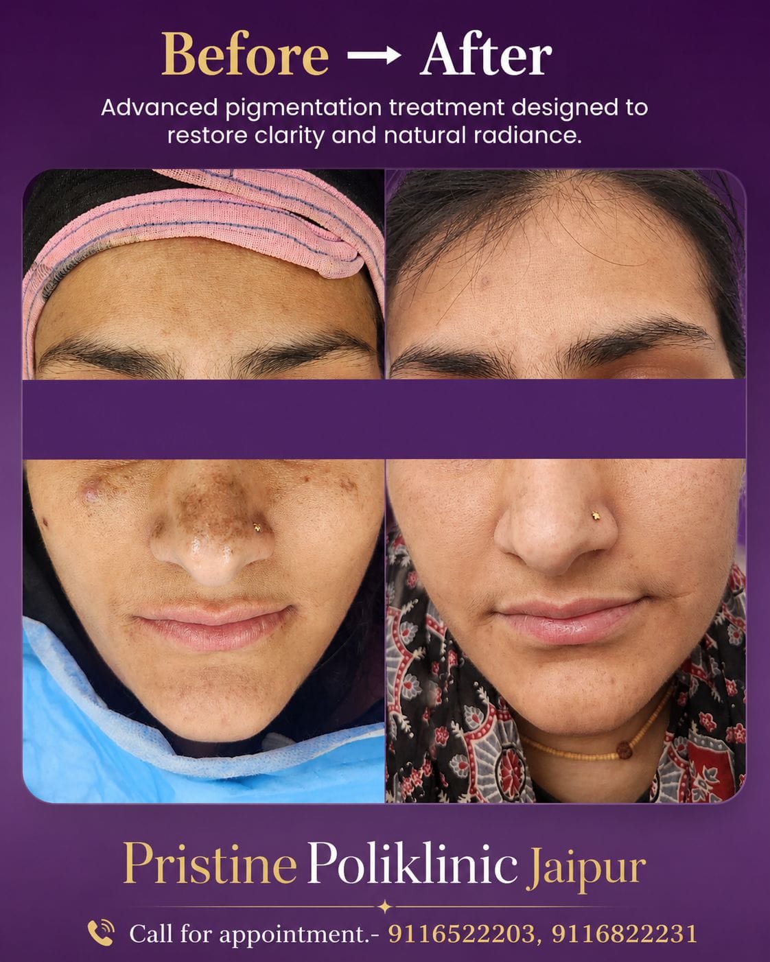 Pigmentation treatment before and after